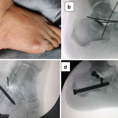 Showing Illustrations For Surgical Technique Marking For Incision On