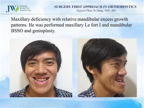 Surgery First Approach In Orthodontics Ppt