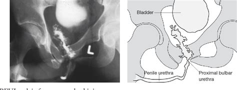 Figure From Pelvic Fracture Urethral Injury In Malesmechanisms Of