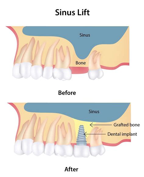 Sinus Lift - Monroe, CT - Huntington, CT - Newtown, CT - Dr. Fatse