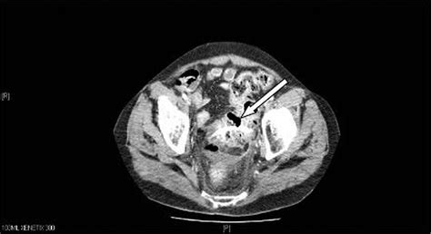 Migrated Biliary Stent Causing Perforation Of Sigmoid Colon And Pelvic Abscess Bmj Case Reports