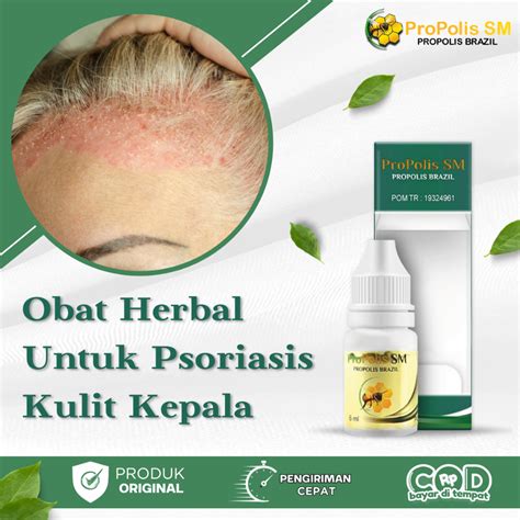 Jual Obat Psoriasis Kulit Kepala Jamur Kulit Kepala Kulit Kepala