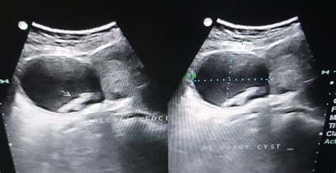 Giant Hemorrhagic Ovarian Cyst With Torsion Rare Case Report