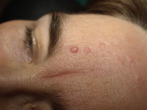 Facts About Seborrheic Keratosis - San Antonio & Boerne Dermatologist