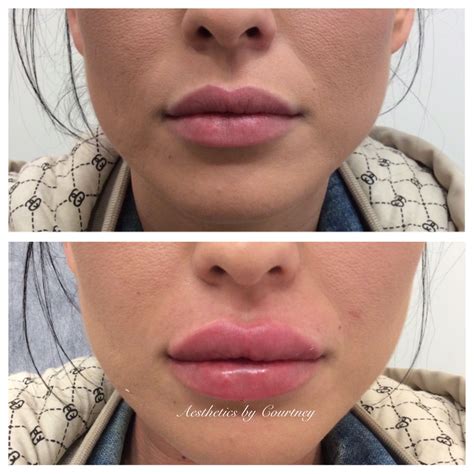 Are Lip Fillers Attractive Differentiates Bloggers Image Database