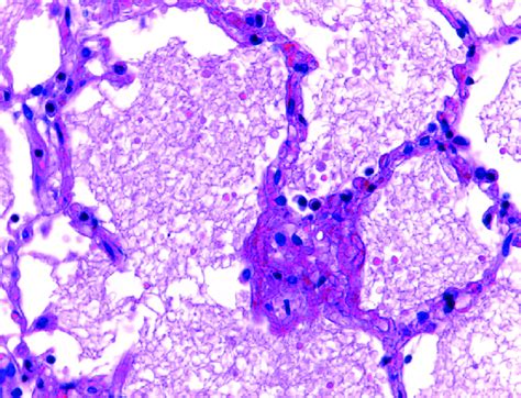 Parénquima Pulmonar Con Edema Intraaveolar He 40× Download