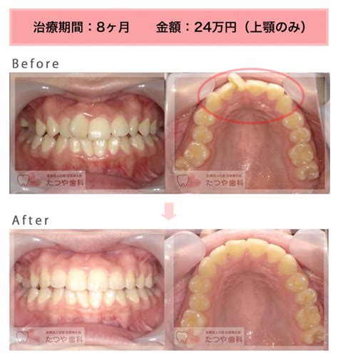 少しのねじれ 症例紹介 東京の【安い前歯だけの部分矯正】部分矯正のたつや歯科