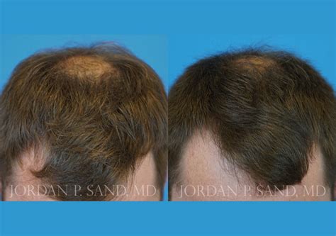 Prp To Scalp 1 Sand Plastic Surgery Of Spokane