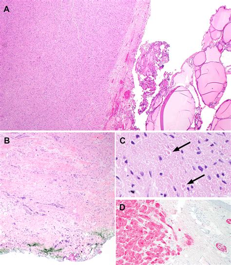 Histological Features Of Gct Case A The Tumor Shows A Solid Growth