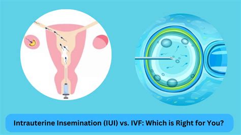 Intrauterine Insemination Iui Vs Ivf Which Is Right For You