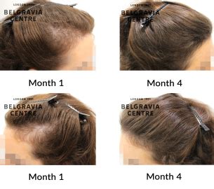 Hair Loss Success Story I Am Very Happy With My Results Highly