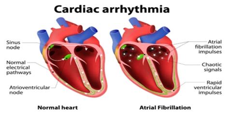 Arrhythmia Causes Symptoms And Treatment Assignment Point