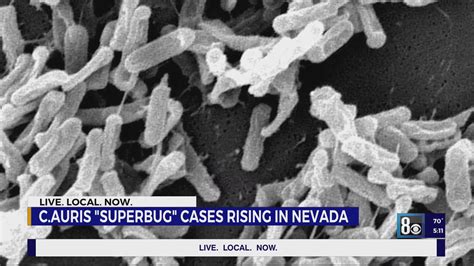 'Superbug' cases rising in Nevada over past two months: health officials