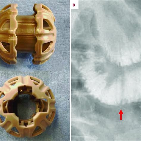 (A) Biofragmentable anastomosis ring (Valtrac, 25 mm, 1.5 …