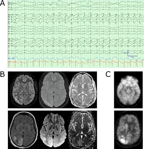 (A) Example of lateralized periodic discharges in the right posterior