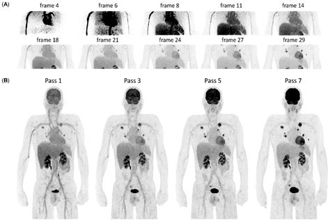 (PDF) Dynamic and Parametric Whole-Body FDG PET/CT Imaging …