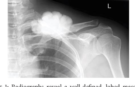 (PDF) Parosteal Osteoma of the Clavicle - ResearchGate