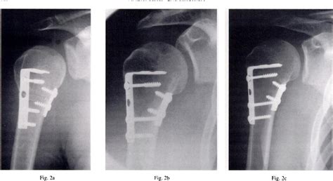 (PDF) Reverse V Osteotomy of the Distal Humerus for the …