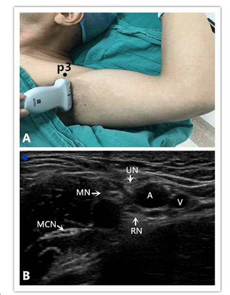 (PDF) Ultrasound Guided Axillary Nerve Block Pdf Pdf