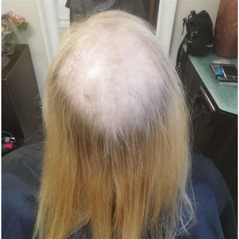 * *Alopezie-Perücken: