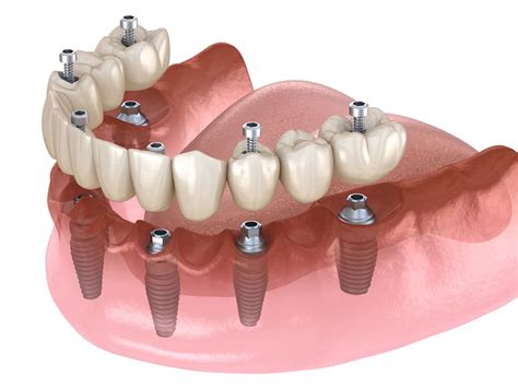 dental implants casino