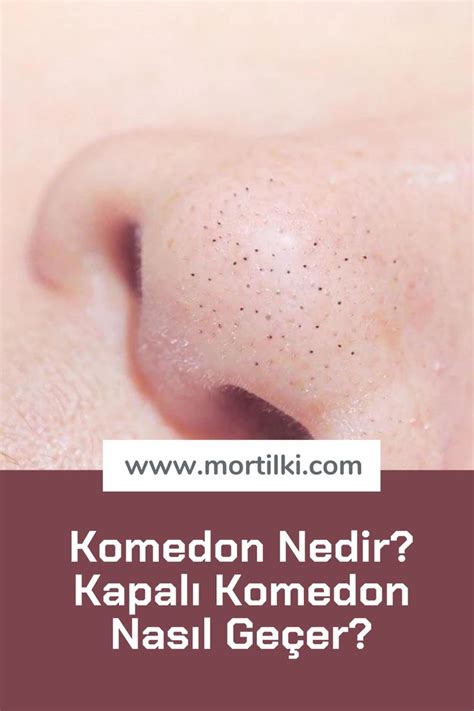 komedon nasıl geçer