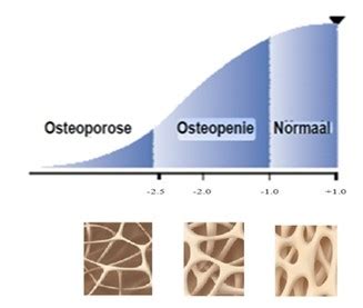 wat betekent t-score bij osteoporose