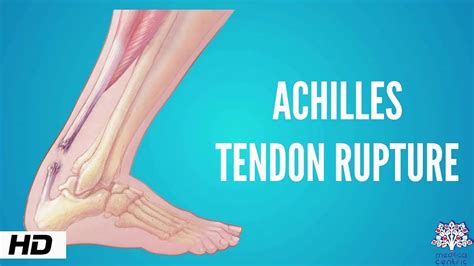 [Achilles tendon rupture-Part 1: etiology and diagnostics]