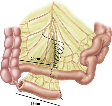 [Complications of Bricker ileal conduit urinary diversion