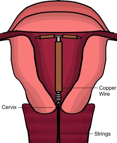 [DIAGRAM] Cervix Diagram Iud