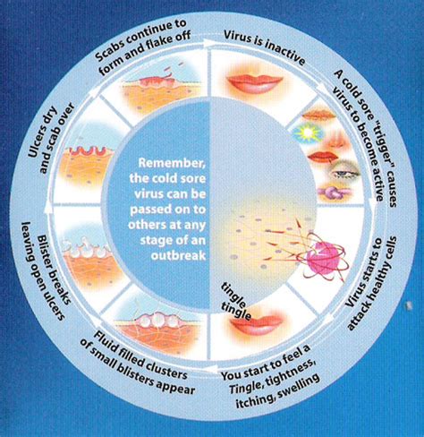 [DIAGRAM] Diagram Of Cold Sore