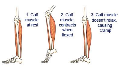 [DIAGRAM] Muscle Cramp Diagram