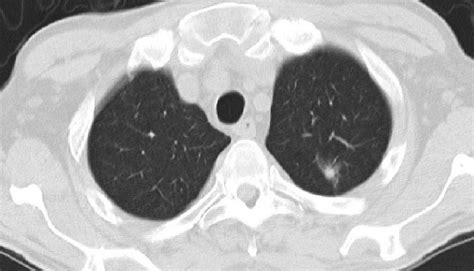 [Diagnosis and Treatment of Pulmonary Ground-glass Nodules]