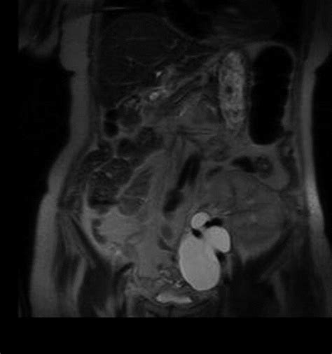 [Laparoscopic fenestration of lymphoceles after kidney transplantation]