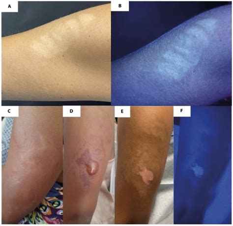 [PDF] Localized Vitiligo and PostInflammatory Hypopigmentation at the