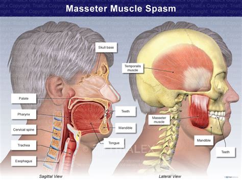 [PDF] MASSETER SPASM IN AN UNDIAGNOSED CASE OF.