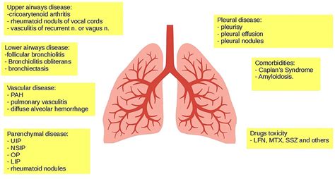 [PDF] Rheumatoid Arthritis Associated Interstitial Lung Disease in ...