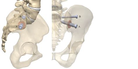 [PDF] SImmetry ® Sacroiliac Joint Fusion System with SImmetry ...