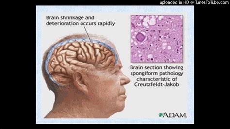 [Prion diseases or transmissible spongiform encephalopathies]