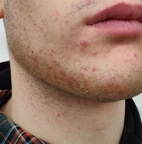 [Routine Help] Dealing with post-shave pimples. - balustradellc