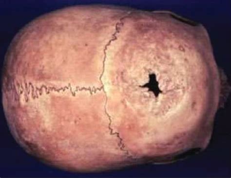 [The mystery of prehistoric trepanations: Is neurosurgery the world ... - wintechmobiles.com