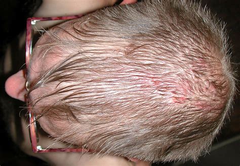 |Sebaceous Adenitis can cause blistering, itching, hair-loss, and infections