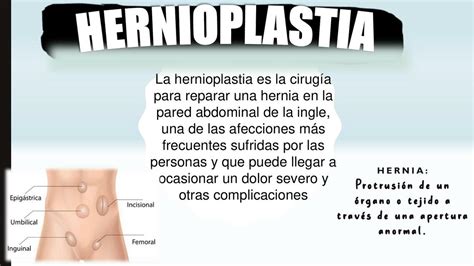 ¿Qué es la hernioplastia? - Spiegato