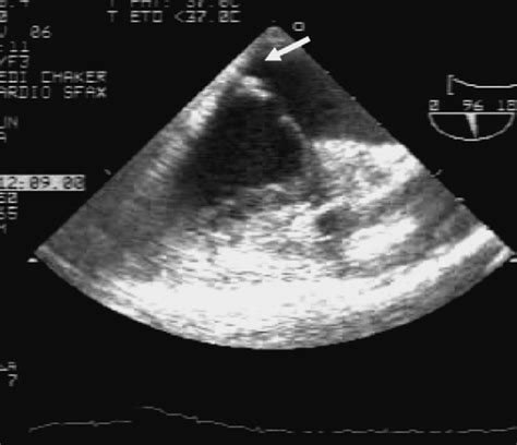 Échocardiographie transœsophagienne pour le diagnostic des …