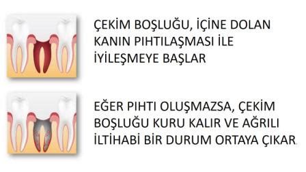 Ömürevleri Diş Kliniği Diş çekimini takiben oluşan boşluklar bir . 