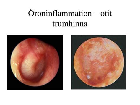 Öroninflammation antibiotika