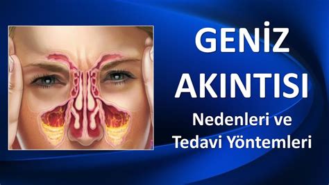 şte geniz akıntısına iyi gelen şeyler…, Geniz Akıntısı Özellikle mevsim geçişlerinde sıklıkla yaşanan geniz akıntısı pek çok kişinin ortak problemleri arasında yer almaktadır.