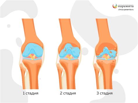 Артроз коленного сустава - причины и лечение