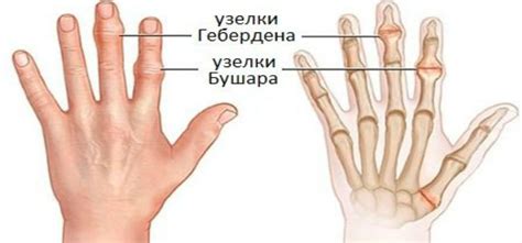 Синовиальный происхождения боли в суставах пальцев рук