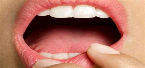 Кондиломи в устата симптоми - comercialexposito.com